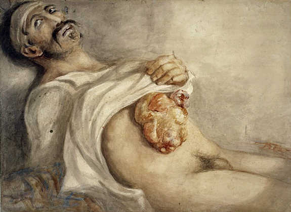 Sabre wound to abdomen, Peltier, Belgian Hospital, 2 July. Wounded at the Battle of Waterloo. Watercolour Charles Bell, 1836. Wellcome Images L0028898